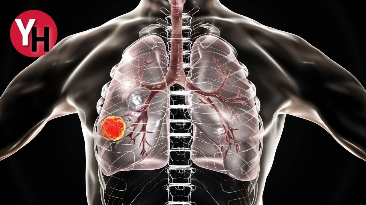 Akciğer Kanseri Hayat Kurtarmak İçin Erken Teşhis