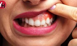 Diş Eti Şişmesinin Nedenleri ve Tedavi Yöntemleri Nedir?