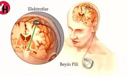 Parkinson Tedavisinde En Etkili Yöntem Beyin Pili Nedir?
