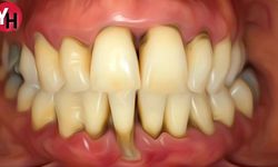 Diş Eti Çekilmesi ve Diş Eti İçin Kullanılan Diğer Bitkisel Kürler