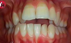 Diş Eti Çekilmesi ve Diş Eti İçin Önerilen Egzersizler