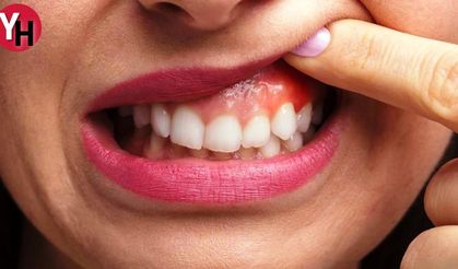 Diş Eti Şişmesinin Nedenleri ve Tedavi Yöntemleri Nedir?