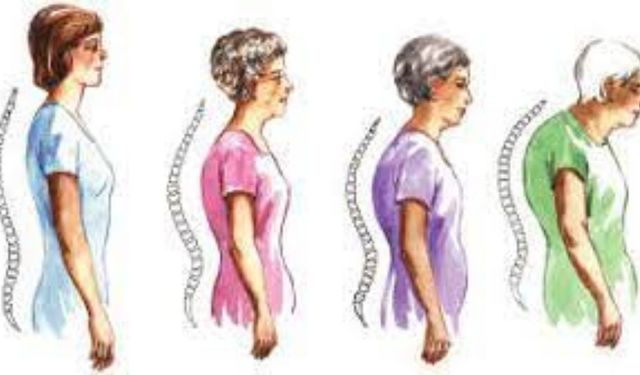 Kadınların Kemik Sağlığı: Osteoporozun Sessiz Tehlikesi ve Önleme Yolları"