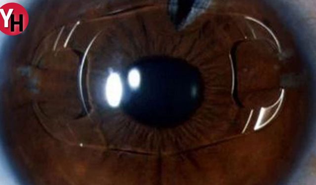 Göz İçi Lens (ICL): Görme Sorunlarınızı Düzeltmek İçin Etkili Bir Çözüm