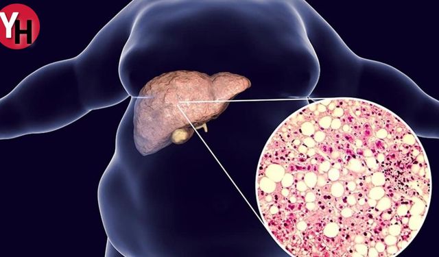 Karaciğer Yağlanması Belirtileri ve Tedavi Yöntemleri
