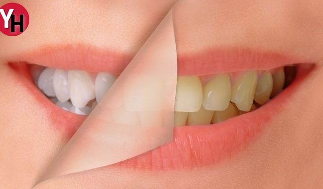 Evde Diş Beyazlatma! Diş Beyazlatmanın Püf Noktaları: Uzun Süreli Etki için Öneriler