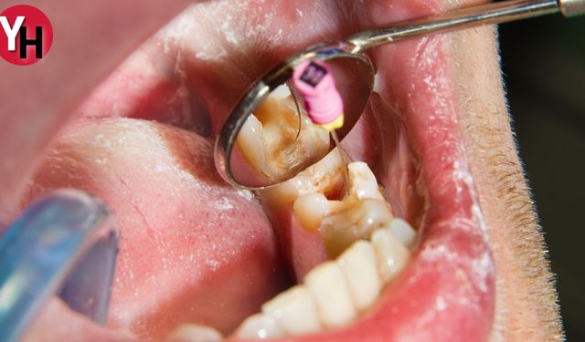 Endodonti  Nedir? Endodonti Tedavisi Nedir? Dişlerdeki İltihap ve Hasarları Tedavisi Nedir?