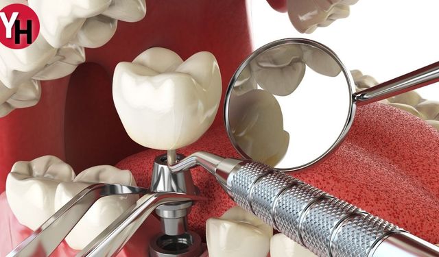 Diş Sağlığı İçin Çığır Açan Teknoloji: İmplant Nedir?