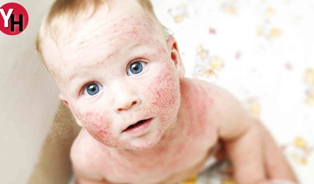 Bebeklerde Alerjik Hastalıklar ve Belirtileri