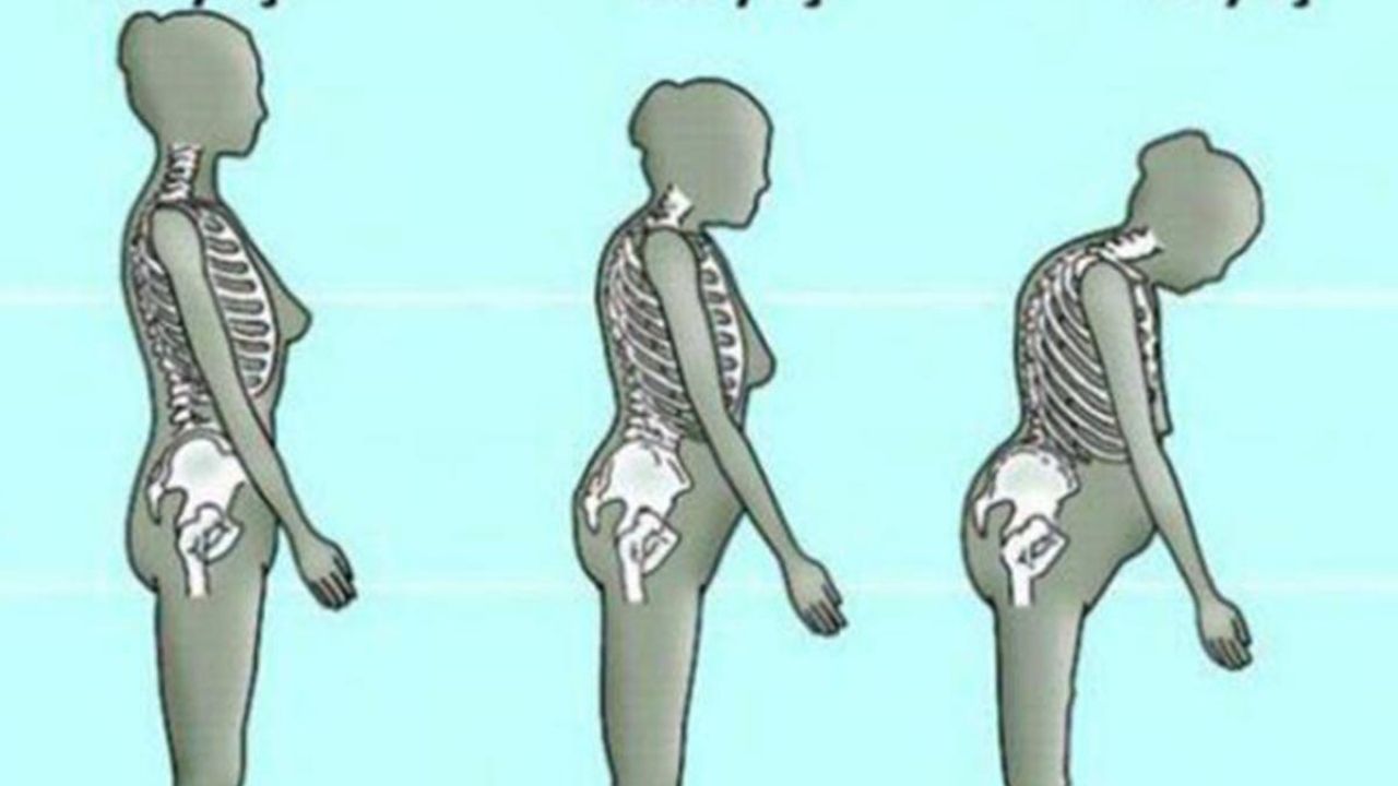 Kadınların Kemik Sağlığı Osteoporoz (1)