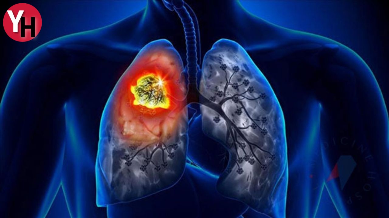 Prof. Dr. Celal Tekinbaş Kadınlarda Akciğer Kanseri Artışı! (3)