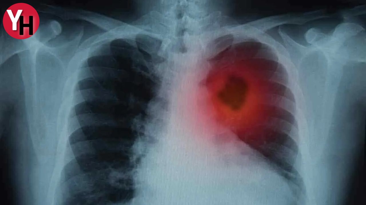 Prof. Dr. Celal Tekinbaş Kadınlarda Akciğer Kanseri Artışı! (4)